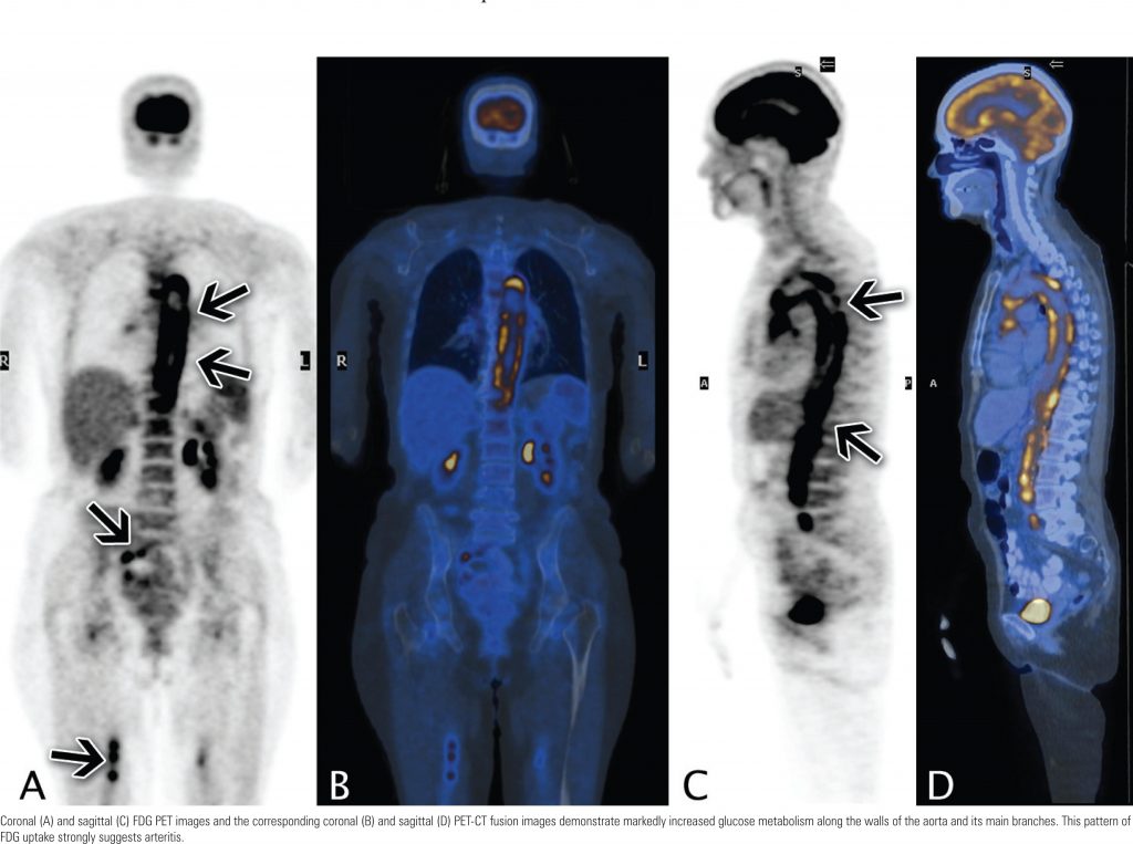 PET-CT findings in arteritis - einstein (São Paulo)