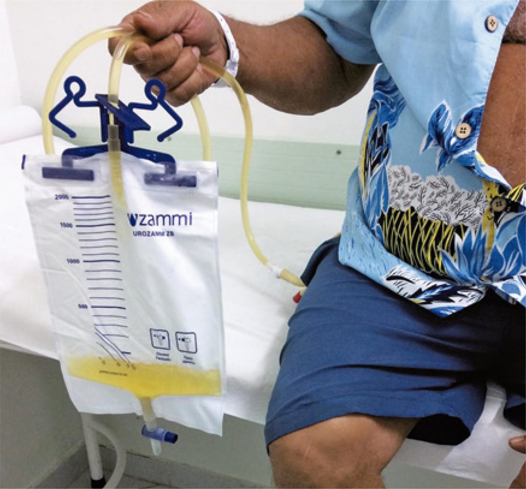 Purple urine bag syndrome case report einstein (São Paulo)