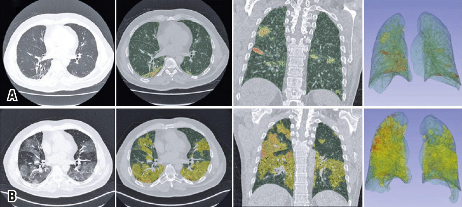 Quantitative analysis in COVID19 report of an initial experience einstein (São Paulo)