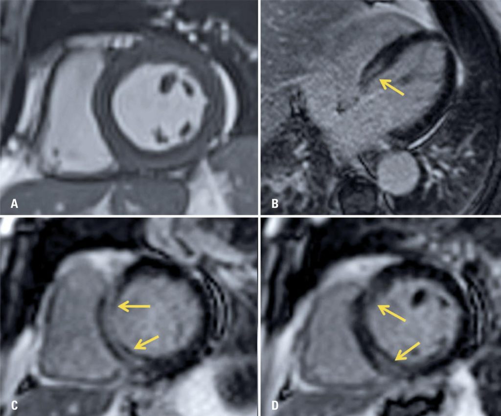 COVID-19 myocarditis: a case report - einstein (São Paulo)