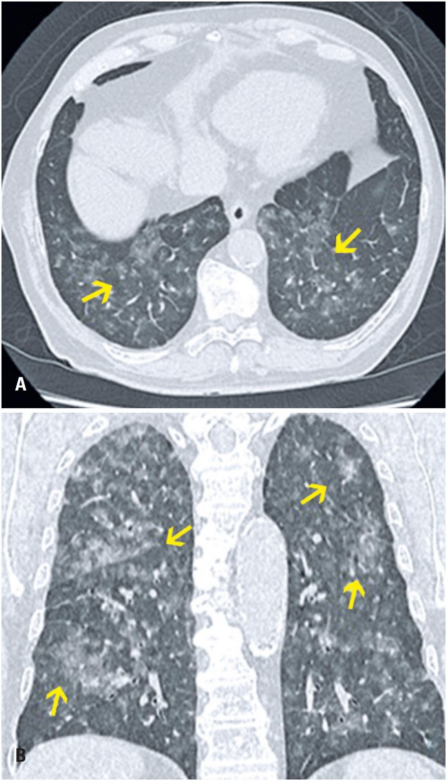 Differential diagnoses of acute groundglass opacity in chest computed