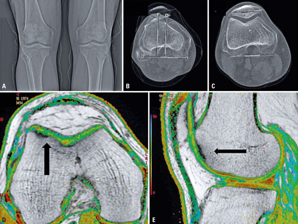 Report of a clinical and laboratory management of cell therapy for knee cartilage in the face of