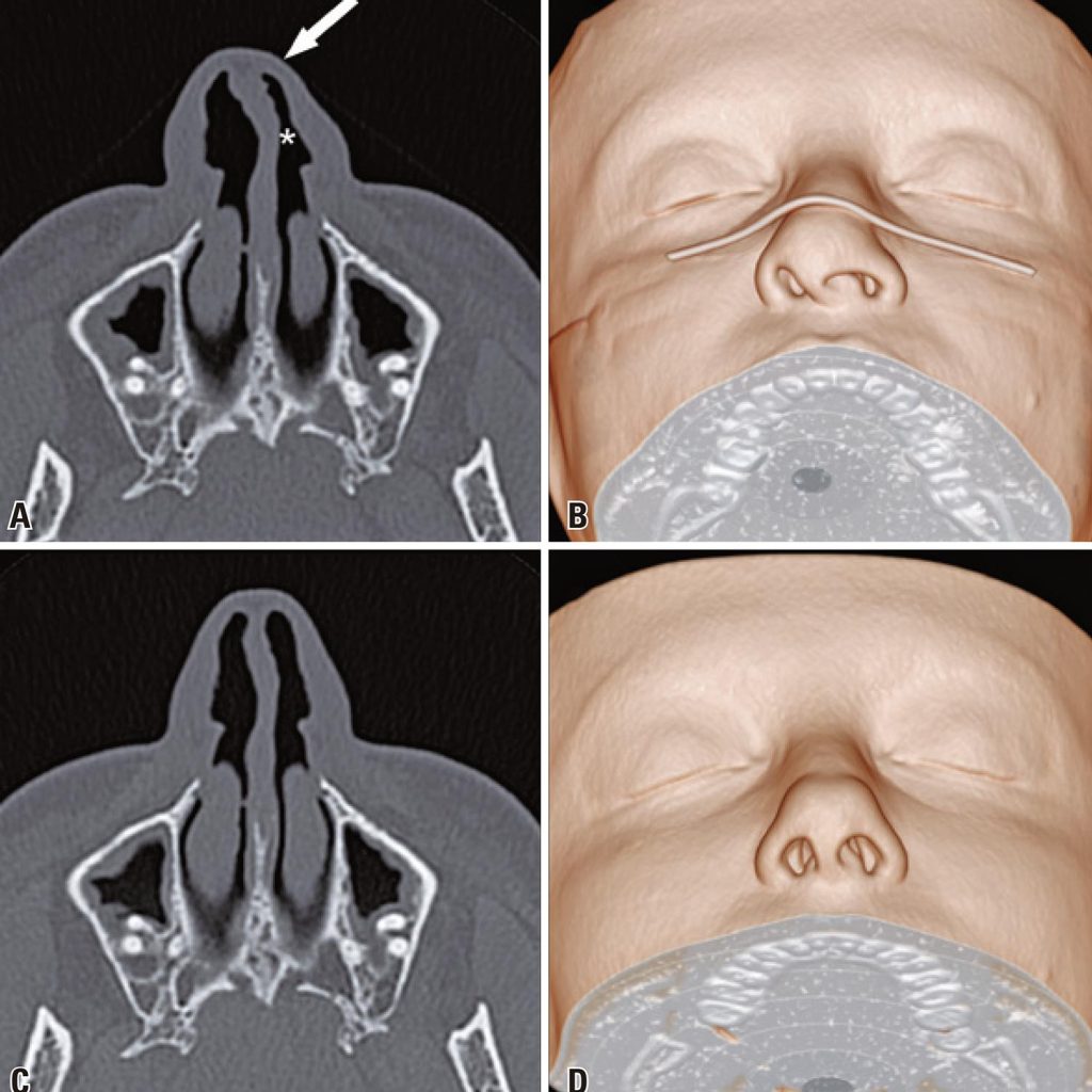 Nasal deformation by face masks on computed tomography einstein (São