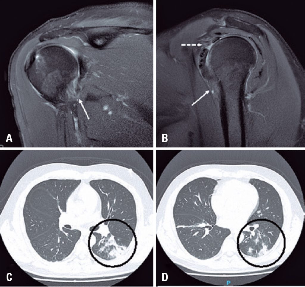 Incidence of adhesive capsulitis of the shoulder during the beginning