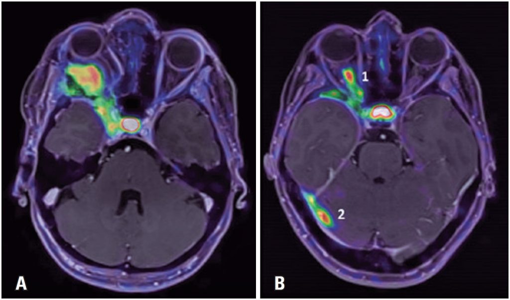Comparative analysis of somatostatin analog uptake between successfully