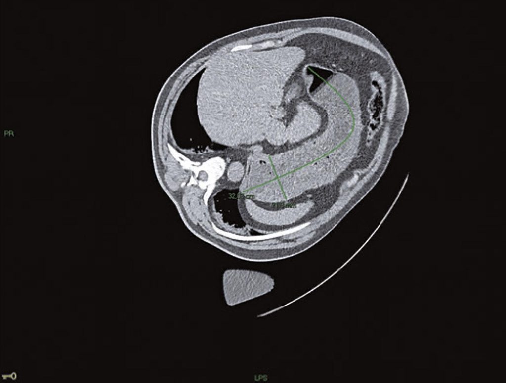 Risk of pulmonary aspiration during semaglutide use and anesthesia in a