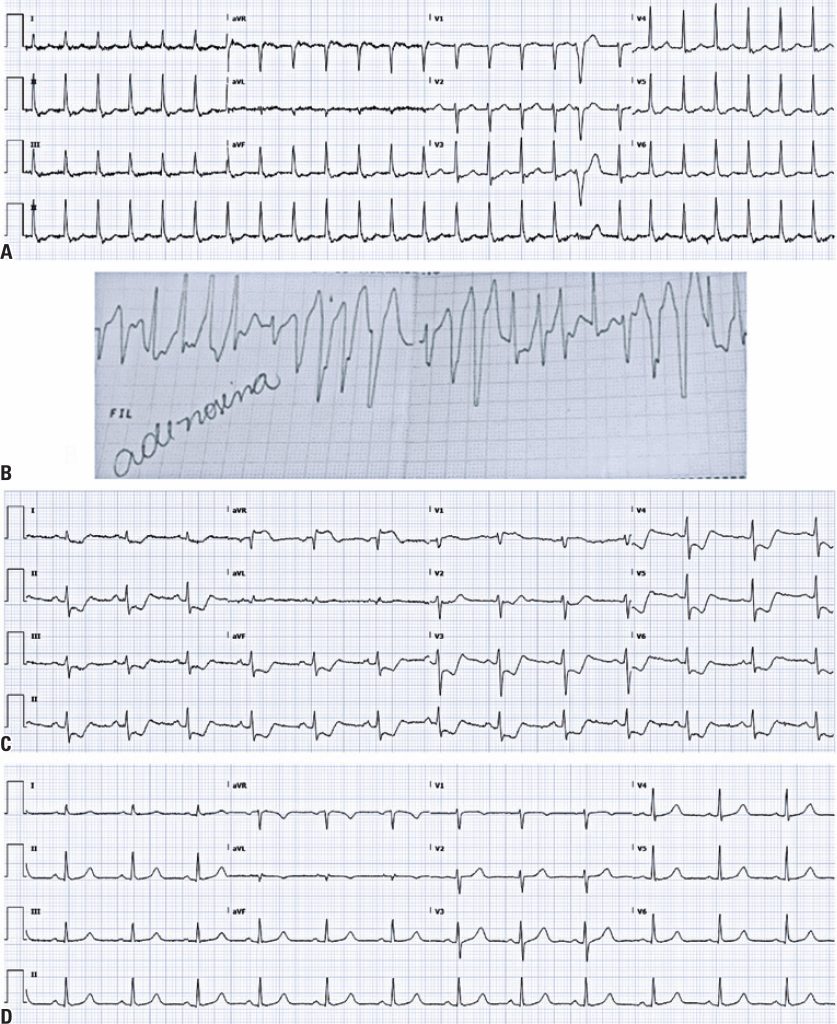 Torsades de pointes and myocardial infarction following reversal of ...